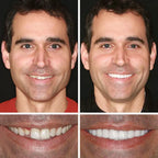 Ends Today: 49.99% OFF! Medical Full Denture with Strong Suction