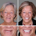 Ends Today: 49.99% OFF! Medical Full Denture with Strong Suction
