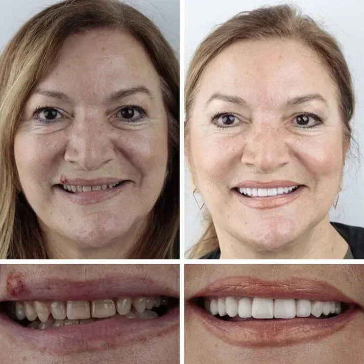 Ends Today: 49.99% OFF! Medical Full Denture with Strong Suction