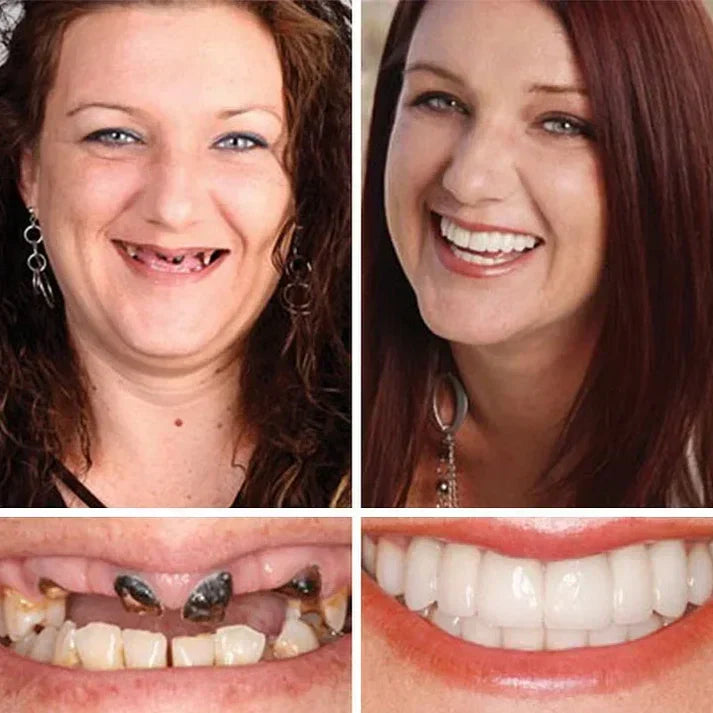 Ends Today: 49.99% OFF! Medical Full Denture with Strong Suction