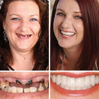 Ends Today: 49.99% OFF! Medical Full Denture with Strong Suction